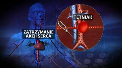 Nowatorska operacja tętniaka 