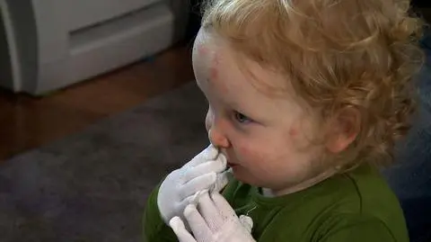 Opatrunki pozwalają chorym normalnie funkcjonować