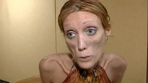 Do czego prowadzi anoreksja