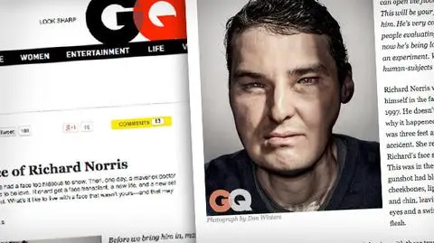 Z nową twarzą po przeszczepie 
na okładkę magazynu 