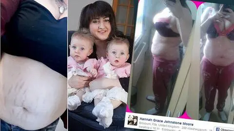 Instagram zablokował jej konto przez zdjęcia rozstępów
