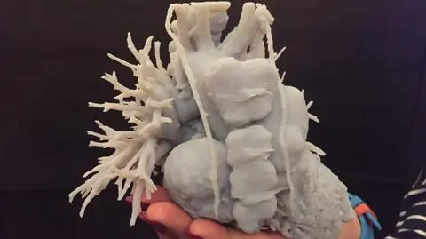 Elbląg: W operacji serca Oktawii pomoże model 3D