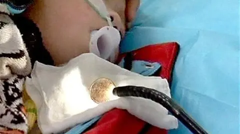 Zjadł monetę. Wyciągnęli ją przez przełyk