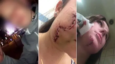 Stanął przed sądem za oszpecenie kobiet 