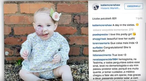 Dziewczynka z naczyniakiem na twarzy. Mama reaguje na komentarze