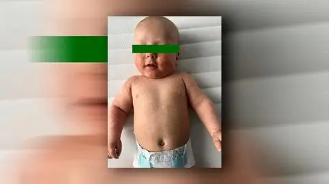 Odra wraca do Polski. Wzrost zachorowań, przybywa pacjentów