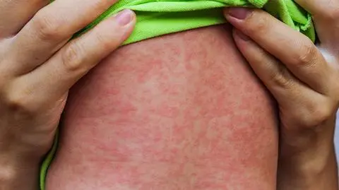 Odra na Ukrainie. Coraz więcej zachorowań