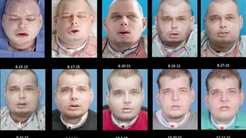 USA. Przełomowy przeszczep twarzy Patricka Hardisona