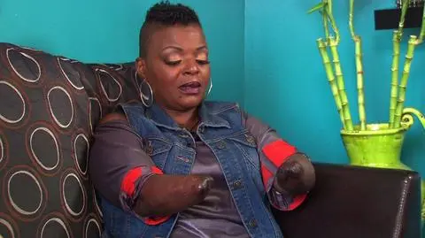 Straciła ręce i stopy