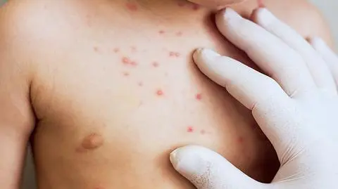 In developed countries, it is recommended that children be immunized against measles at 12 months
