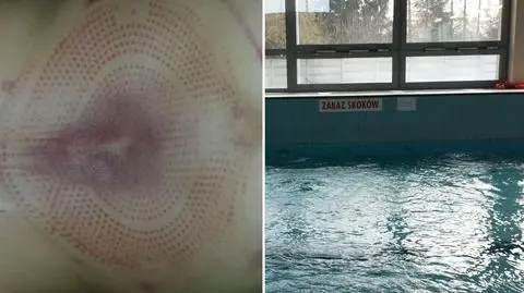 Tak wyglądały plecy 9-latki po kontakcie z dyszą