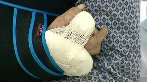 Pierwszy w Polsce przeszczep całej ręki. "To cud"