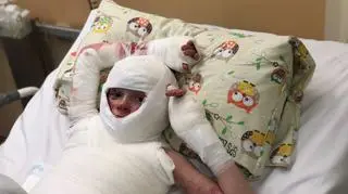 Alan ma poparzone 70 procent ciała