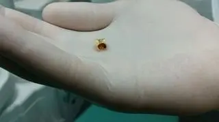 Dentysta stwierdził, że w paczce był ząb trzonowy. Z dziurą i plombą