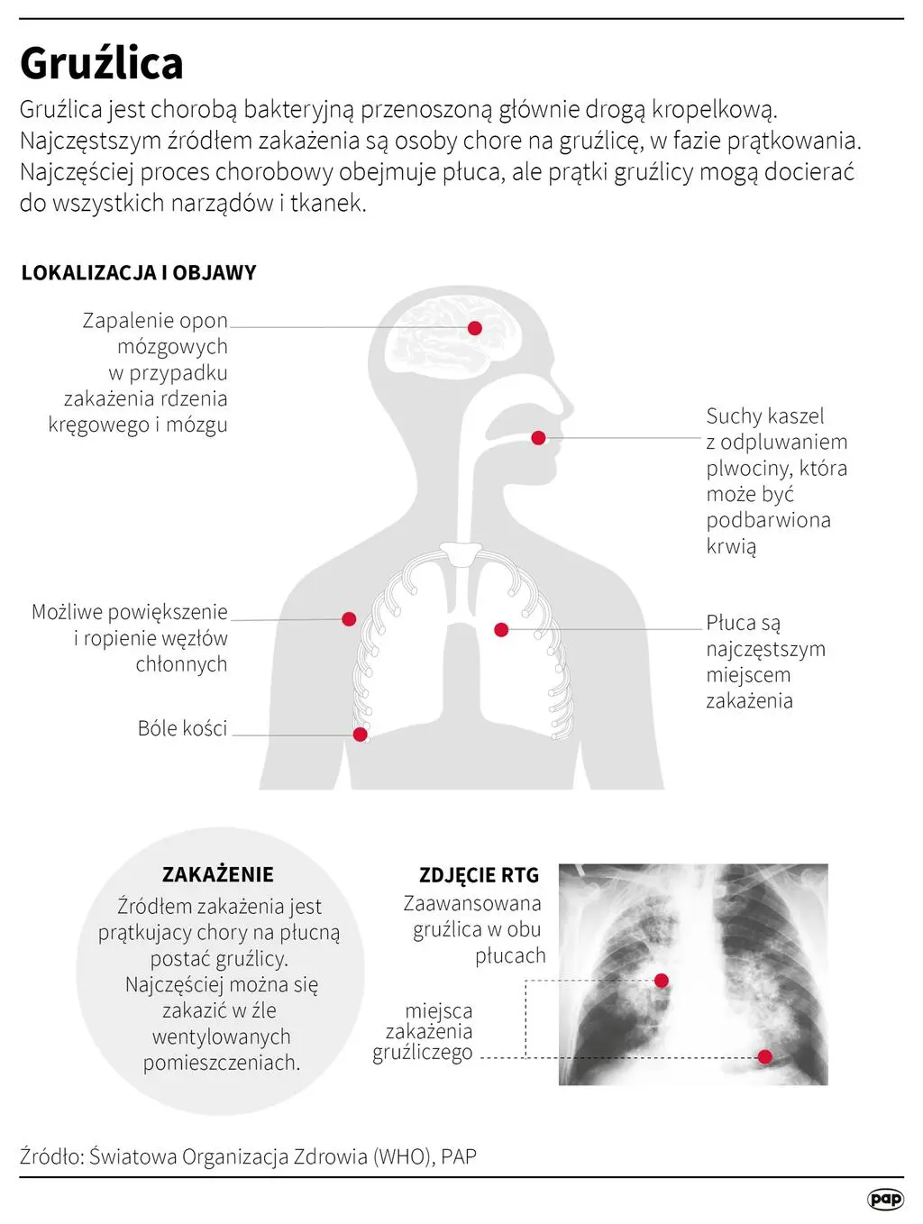 Gruźlica - charakterystyka choroby