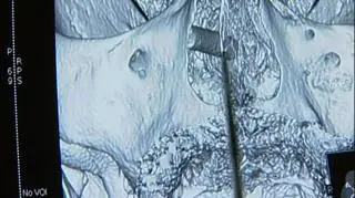 Lekarzom nie udało się usunąć 2 cm ołówka, bo wrósł w tkanki mózgu