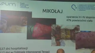 Mikołaj miał poparzone prawie 50 procent powierzchni ciała