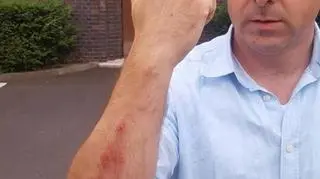 Piotr Łuczyński pokazuje pobijaną rękę