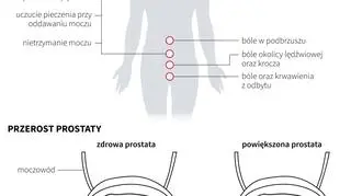 Rak prostaty