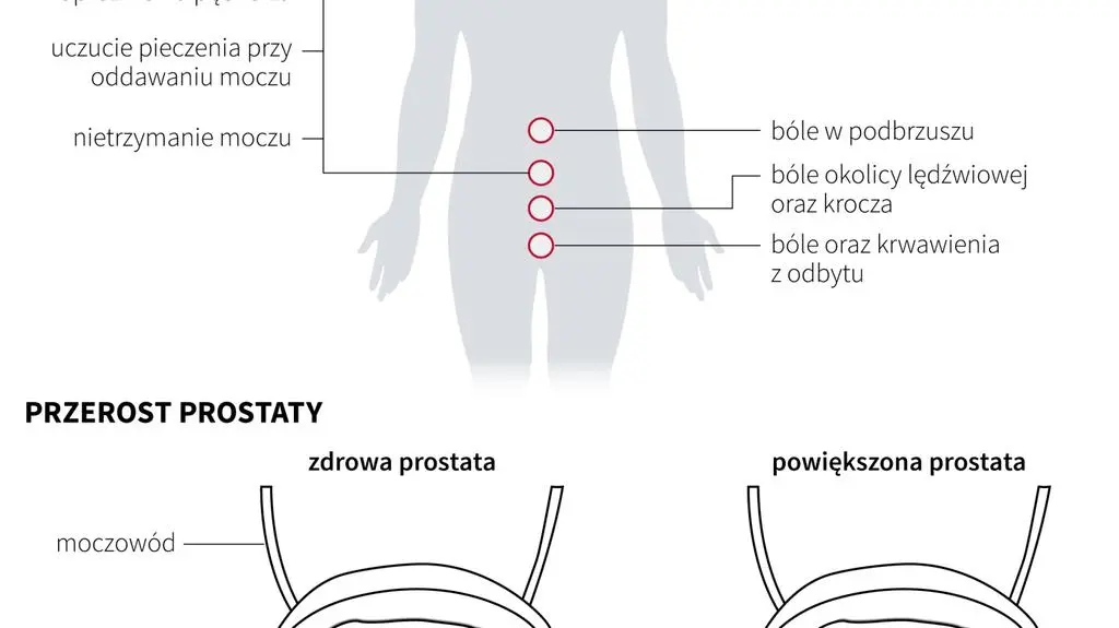 Rak prostaty