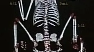 Rentgenowskie zdjęcie szkieletu Lakszmi