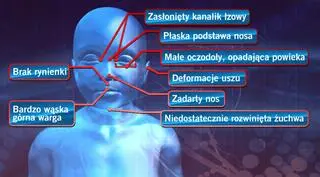 Tak FAS zmienia twarz dziecka