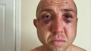 Tak Rafałko wyglądał po pobiciu przez policję