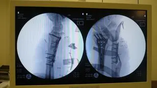 To sukces - mówią lekarze