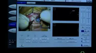 Wycinanie otworu w rogówce pana Jerzego