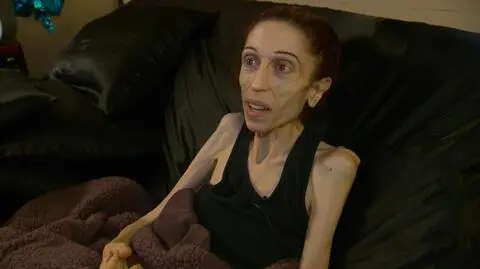 Kobieta choruję na anoreksję od 10 lat 