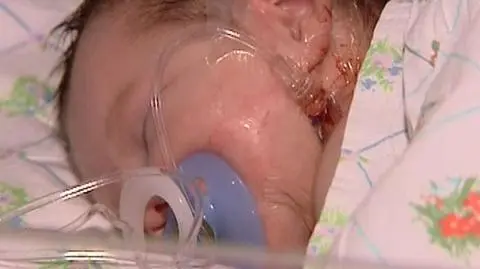 Malutka Marlenka trwale oszpecona