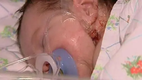 Noworodek poparzony w szpitalu