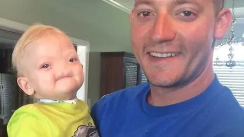 Zmarł Eli. Dwulatek, który urodził się bez nosa