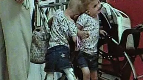 Bliźniaczki syjamskie nie będą rozdzielone
