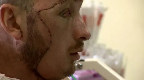 Przeszczep twarzy. Jak to się robi?