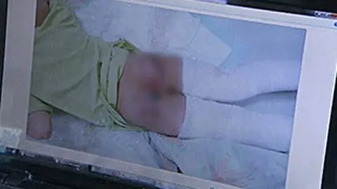 Poparzone dziecko i umorzone śledztwo. Są blizny, nie ma sprawy