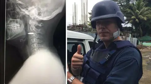 Postrzelony na Filipinach dziennikarz. "Kula wciąż jest w mojej szyi"
