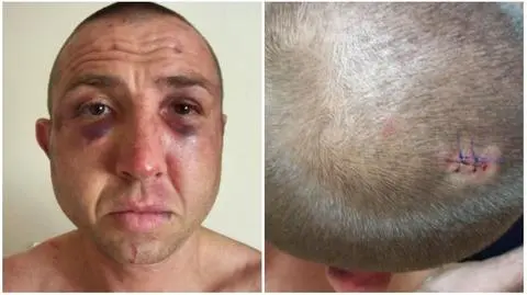 Mężczyzna twierdzi, że został pobity przez policjantów