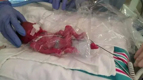 Komplikacje po koniecznej operacji doprowadziły do rozdzielenia bliźniaków