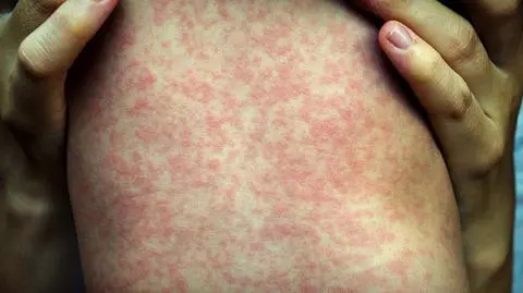 Rośnie liczba chorych na odrę [materiał magazynu "Polska i Świat", 10.12.2018 r.]