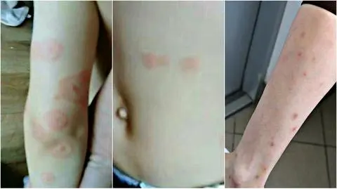 Świnoujście: pluskwy gryzą dzieci