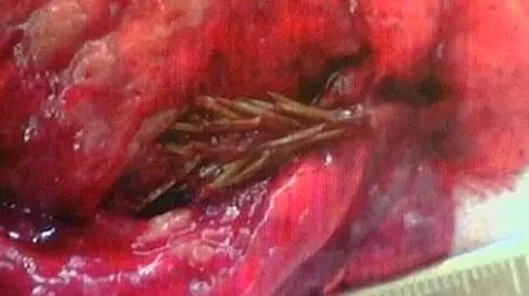 Mężczyzna z drzewem w płucach