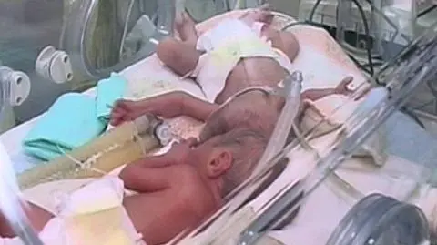 Bliźniaki zrośnięte główkami w Bydgoszczy