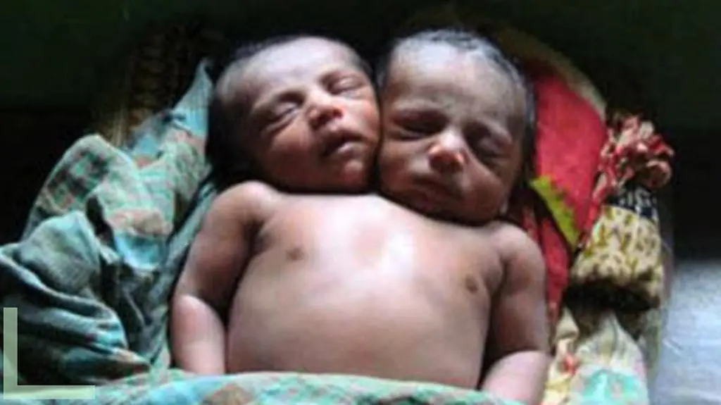 Dwoje dzieci w jednym ciele