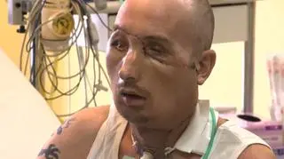 Pan Grzegorz po przeszczepie twarzy robi niewiarygodne postępy
