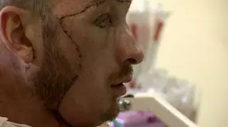 Przeszczep twarzy. Jak to się robi?