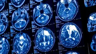 Alzheimer atakuje wcześniej, niż sądzimy. "Łatwo przegapić początki"