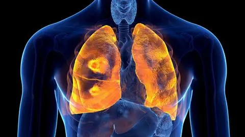 Kiedyś wyrok, dziś choroba przewlekła. "Z rakiem płuc można żyć długie lata"