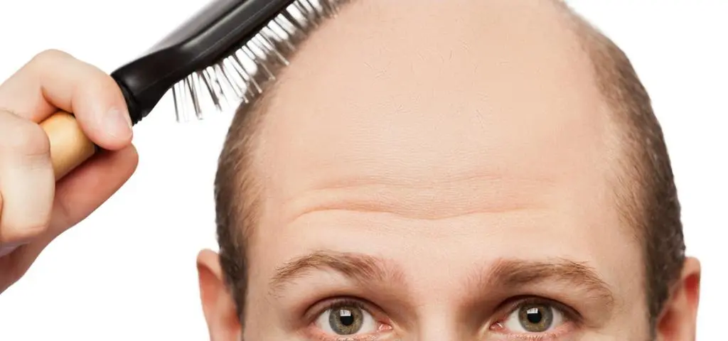 Łysienie można zatrzymać, ale liczy się czas. Kiedy zgłosić się do dermatologa?