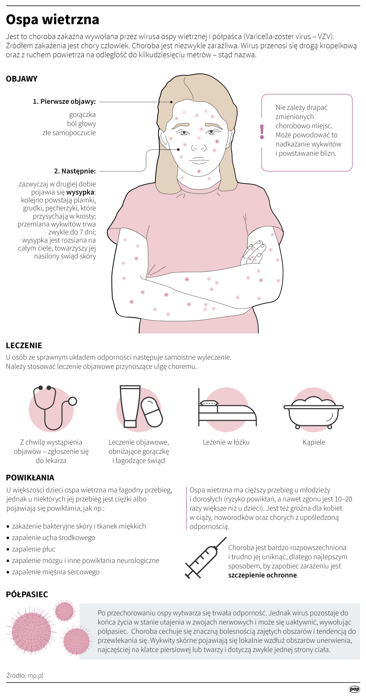 Ospa wietrzna (Maria Samczuk/PAP)